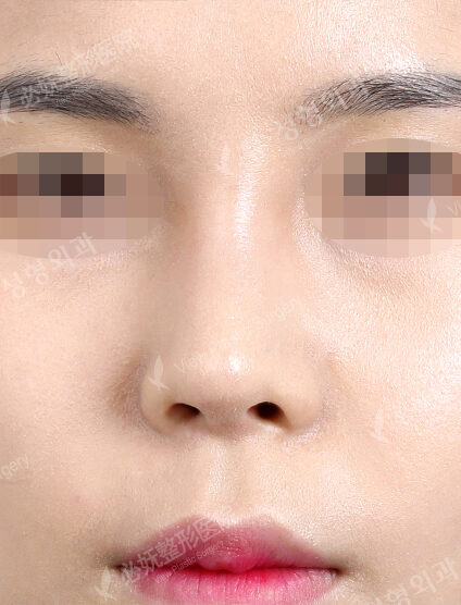 Bulbous Nose (7 Months ) — After