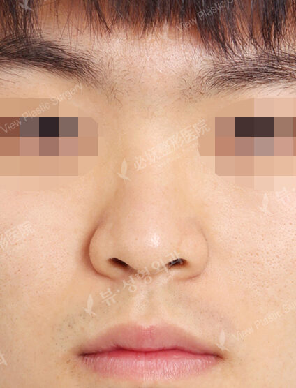 T.O.P Surgery_Low Nose (6 Monthly Checkup) — Before