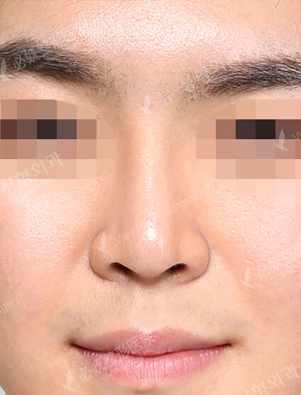 T.O.P Surgery_Low Nose (6 Monthly Checkup) — After