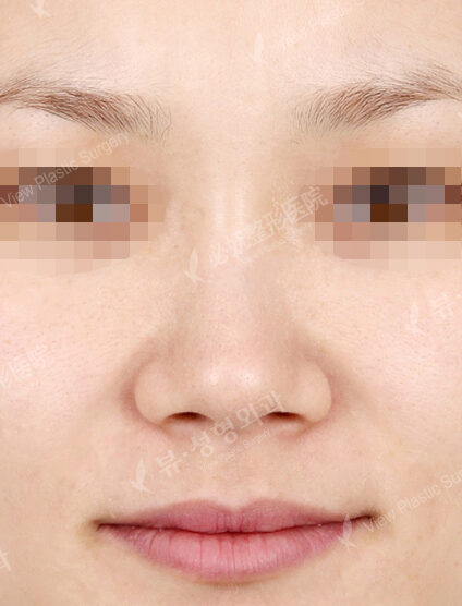 Wide Nose+Weir Reduction (1 Months ) — Before