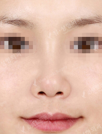 Wide Nose+Weir Reduction (1 Months ) — After