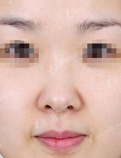 Bulbous Nose (1 Months ) — Before