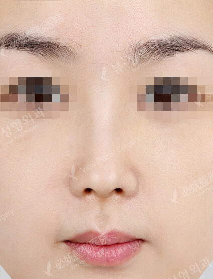 Bulbous Nose (1 Months ) — After