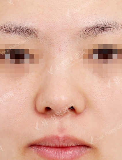 Bulbous Nose (Revisional Rhinoplasty) (1 Months ) — Before