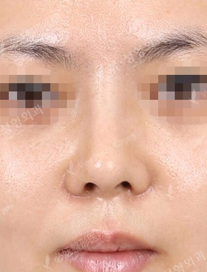 Bulbous Nose (Revisional Rhinoplasty) (1 Months ) — After