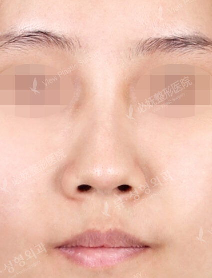 Rhinoplasty (5 Months) — Before
