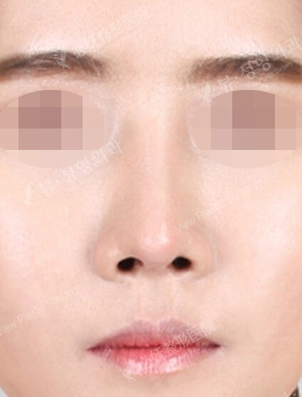 Rhinoplasty (5 Months) — After