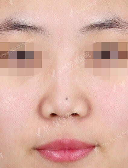 Low Nose (1 Months ) — Before
