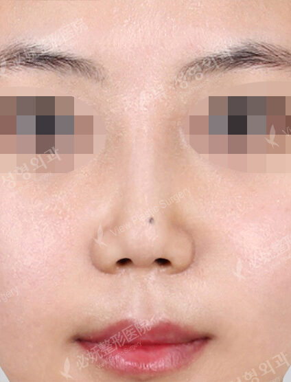 Low Nose (1 Months ) — After