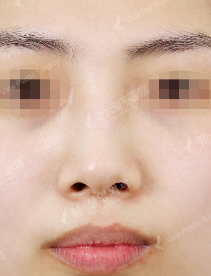 Hump Nose(1 Months ) — Before