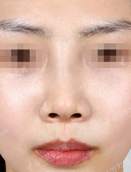 Hump Nose(1 Months ) — After