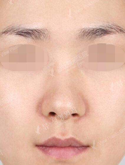 Bulbous Nose+Weir Reduction (2 Months) — Before