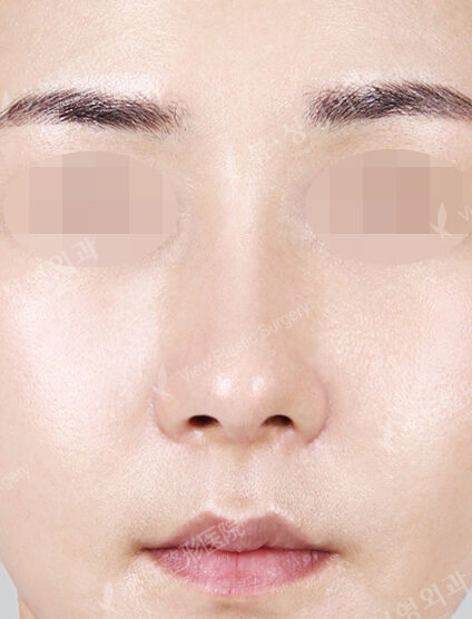 Bulbous Nose+Weir Reduction (2 Months) — After