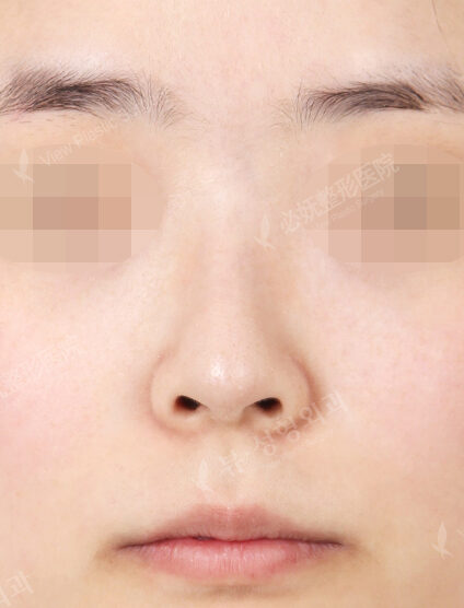 Hump Nose(6 Months) — Before