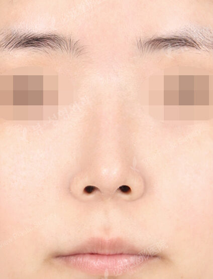 Hump Nose(6 Months) — After