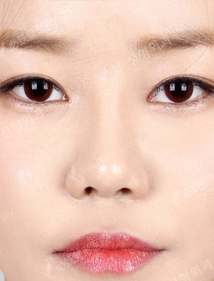Low Nose (1 Months ) — After