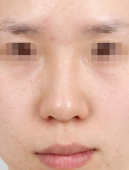 Hump Nose(3 Months ) — Before