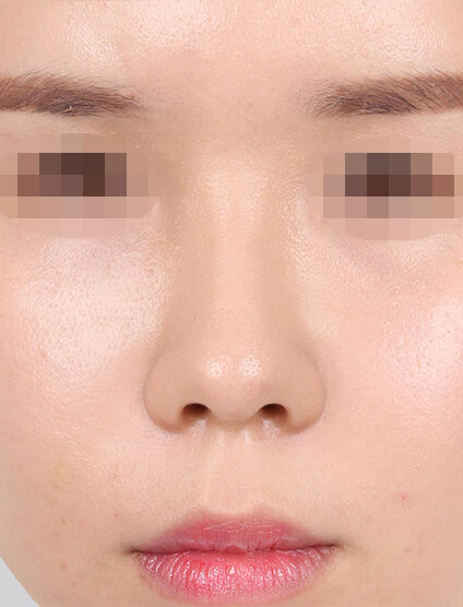 Hump Nose(3 Months ) — After