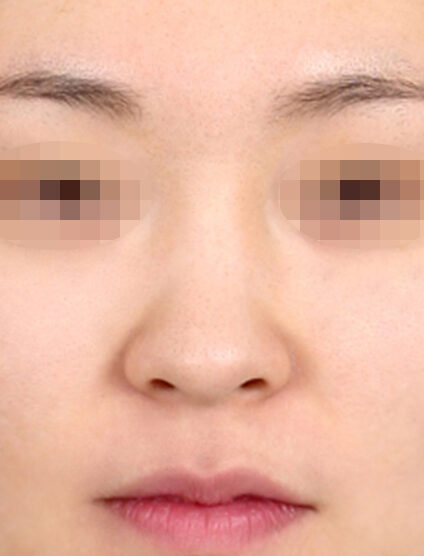 Hump Nose(3 Months ) — Before