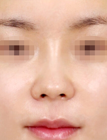 Hump Nose(3 Months ) — After