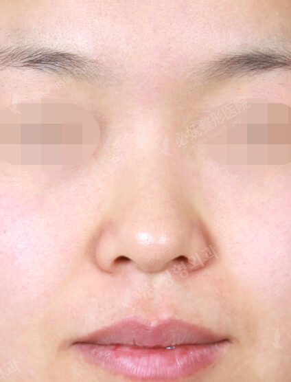 Rhinoplasty (6 Months) — Before