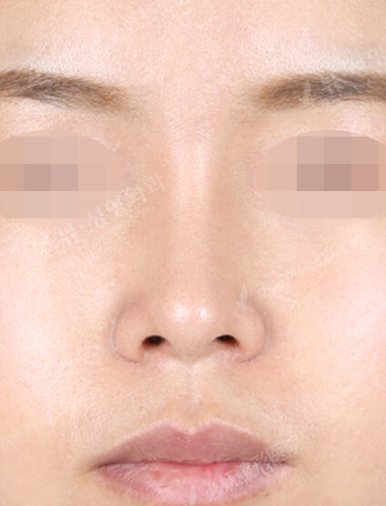 Rhinoplasty (6 Months) — After