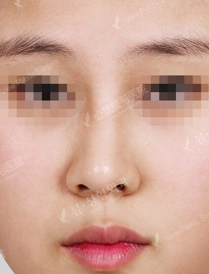 Deviated Nose(5 Months) — Before