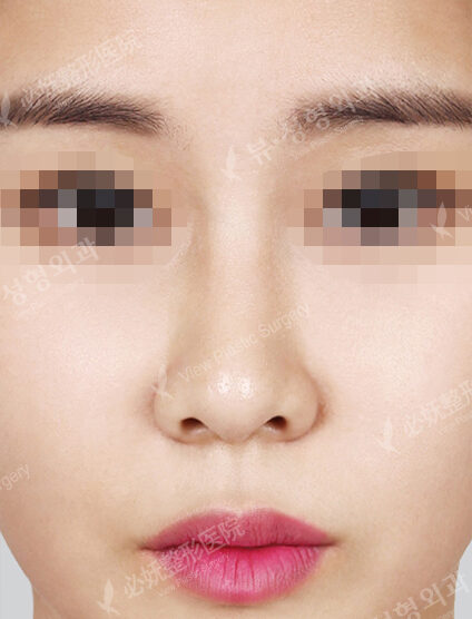 Deviated Nose(5 Months) — After