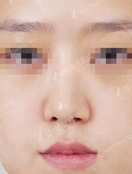 Bulbous Nose (Revisional Rhinoplasty)(7 Months ) — Before