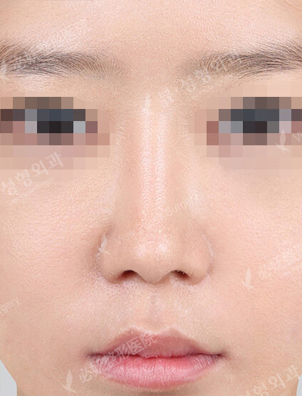 Bulbous Nose (Revisional Rhinoplasty)(7 Months ) — After