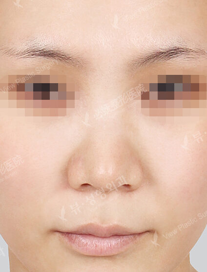 Bulbous Nose (6 Months) — Before