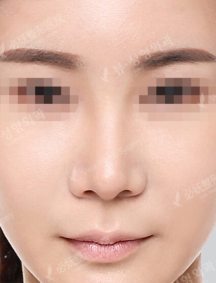 Bulbous Nose (6 Months) — After