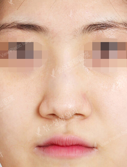 Wide Nose (2 Months ) — Before