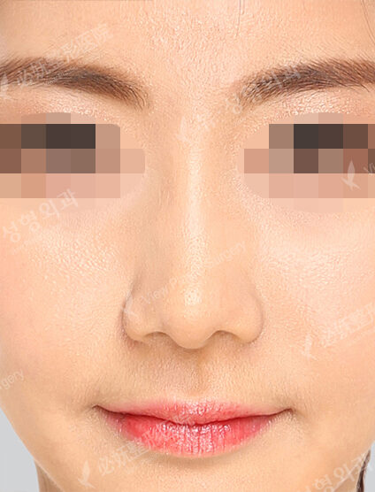 Wide Nose (2 Months ) — After