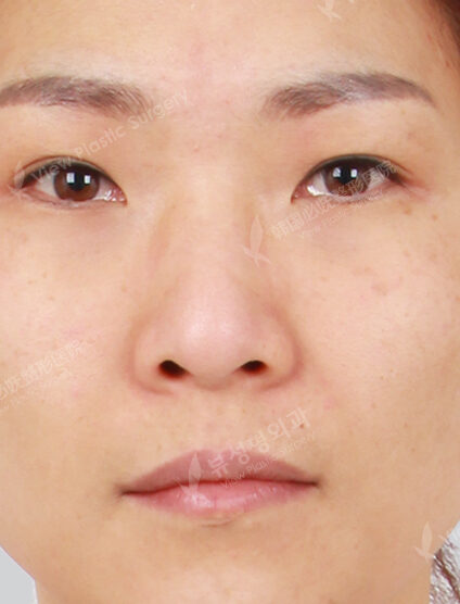 Zygoma Reduction+Hump Nose +Weir Reduction+Fat Graft (Frontal Cheeks , Forehead , Nasolabial)(3 Months) — Before
