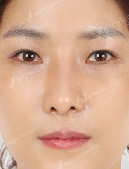 Zygoma Reduction+Hump Nose +Weir Reduction+Fat Graft (Frontal Cheeks , Forehead , Nasolabial)(3 Months) — After
