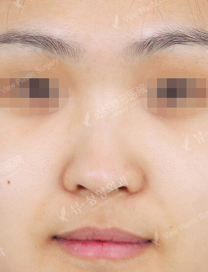 Bulbous Nose (2 Months ) — Before