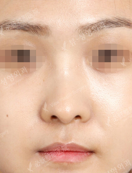 Bulbous Nose (2 Months ) — After
