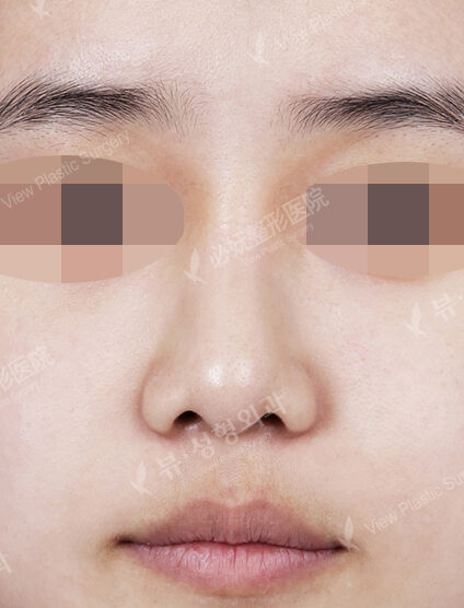Bulbous Nose (Revisional Rhinoplasty)(6 Months) — Before