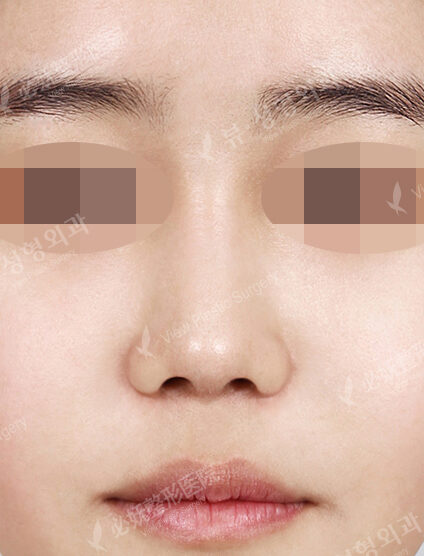 Bulbous Nose (Revisional Rhinoplasty)(6 Months) — After