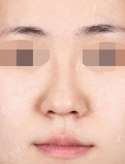 Hump Nose(3 Months) — Before