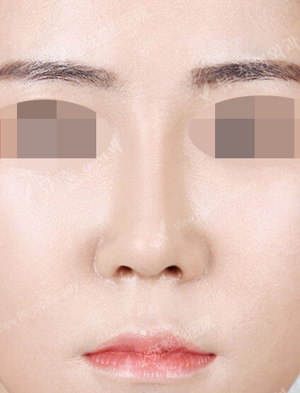 Hump Nose(3 Months) — After