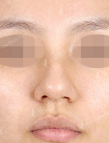 Hump Nose(5 Months) — Before