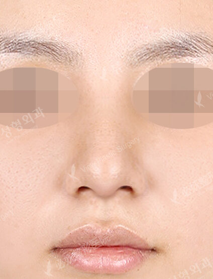 Hump Nose(5 Months) — After