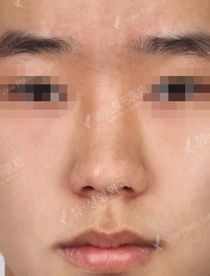Wide Nose (2 Months) — Before