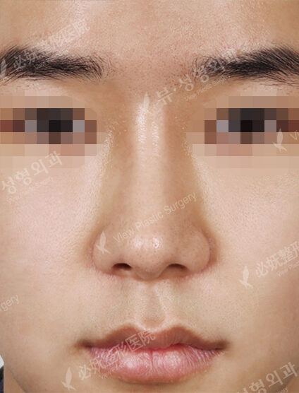 Wide Nose (2 Months) — After