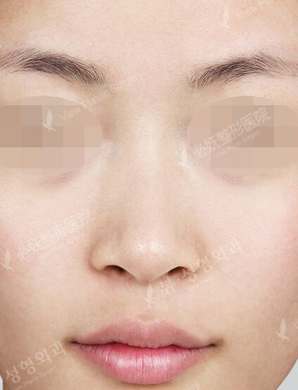 Rhinoplasty (7 Months) — Before