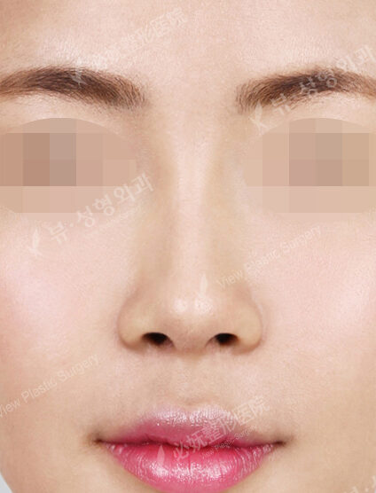 Rhinoplasty (7 Months) — After