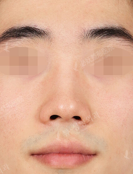 Hump Nose(3 Months) — Before