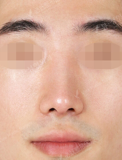 Hump Nose(3 Months) — After